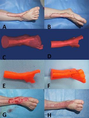 Application of 3D Printed Models of Complex Hypertrophic Scars for Preoperative Evaluation and Surgical Planning